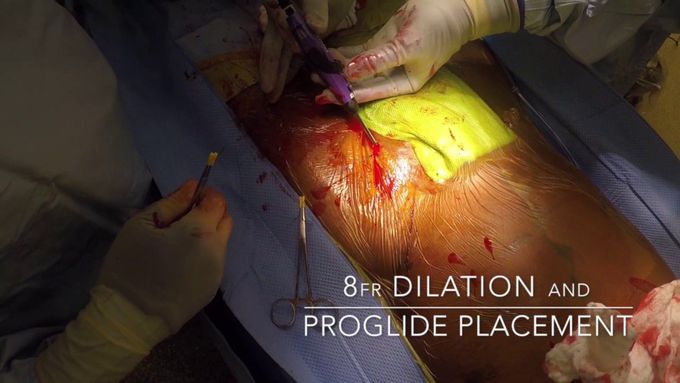 Percutaneous and Open Cannulation for Peripheral Cardiopulmonary Bypass: Pearls and Pitfalls