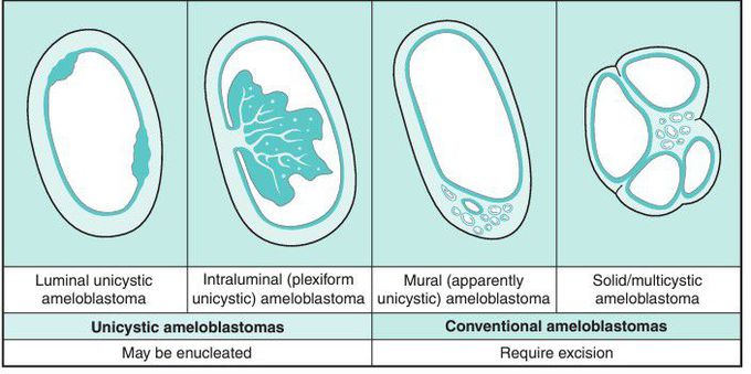 Unicystic presentation of ameloblastoma