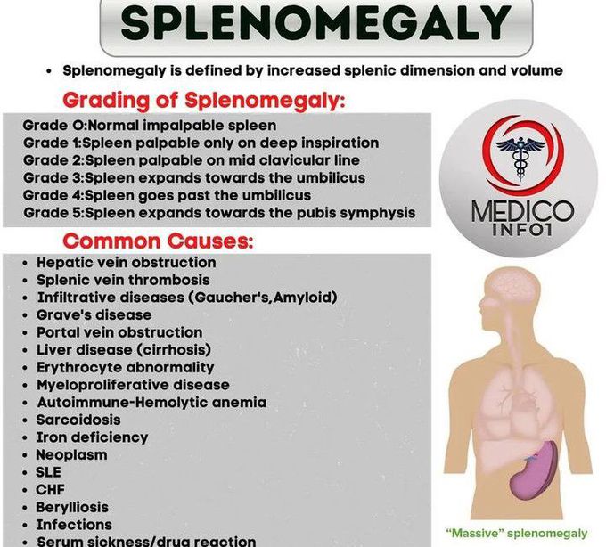 Splenomegaly