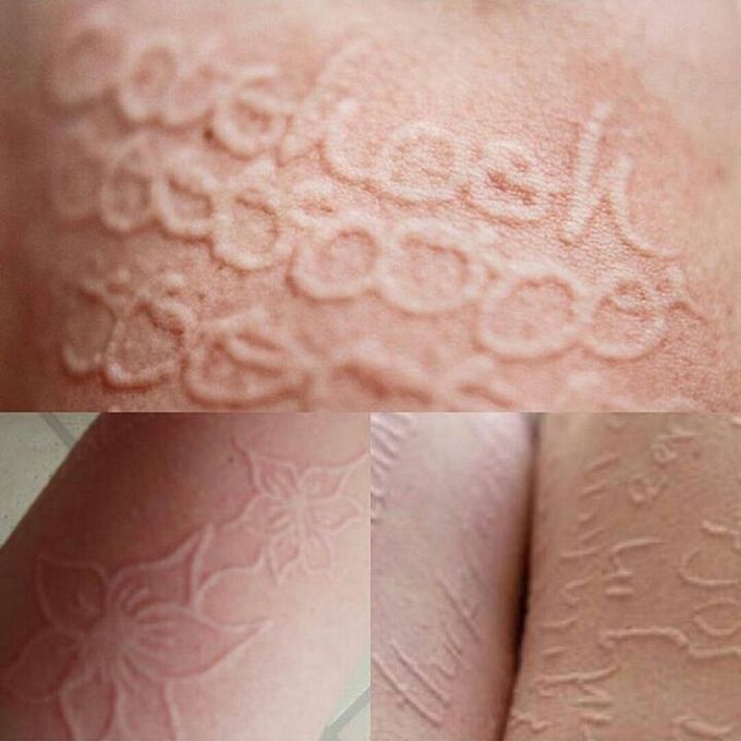 Dermatographia