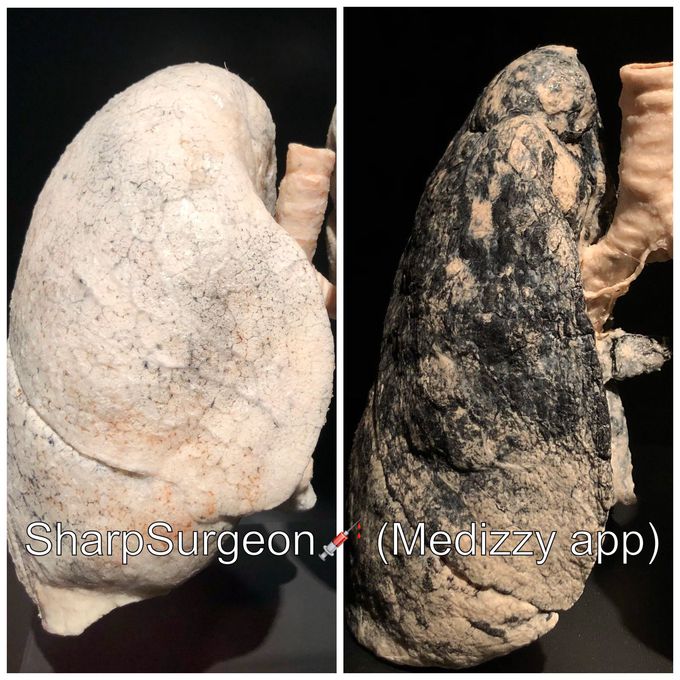Normal lungs vs Smoker’s lungs! 😱🚬