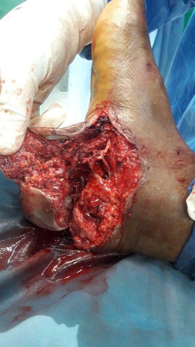 Foot accident