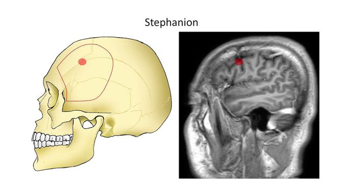 Awake craniotomy for a cavernous angioma in the Broca’s area