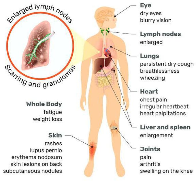 Sarcoidosis