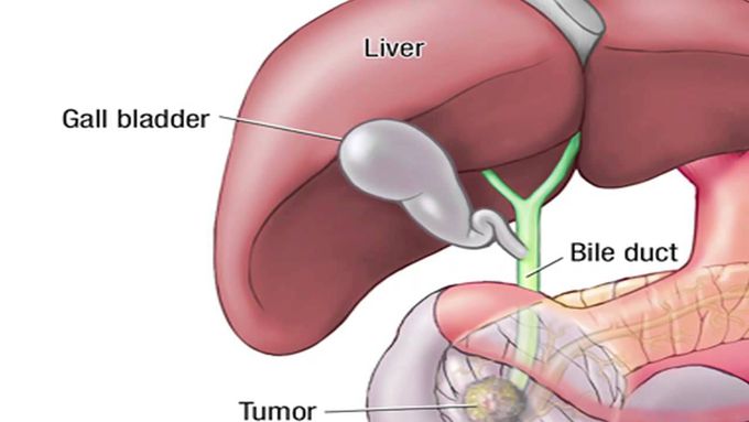 Whipple's procedure