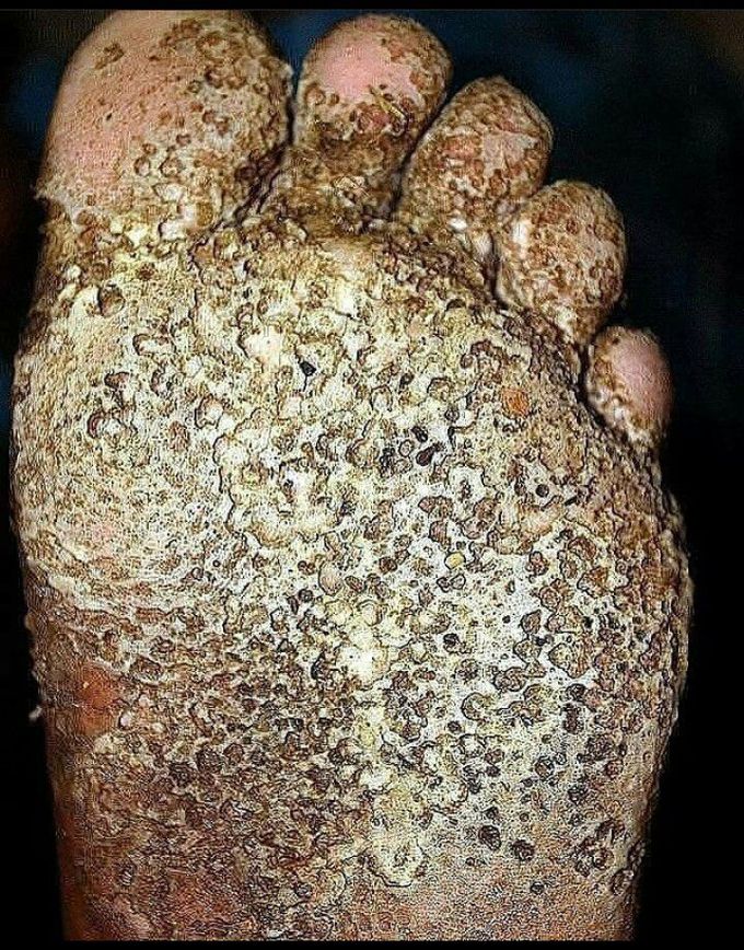 Pitted Keratolysis