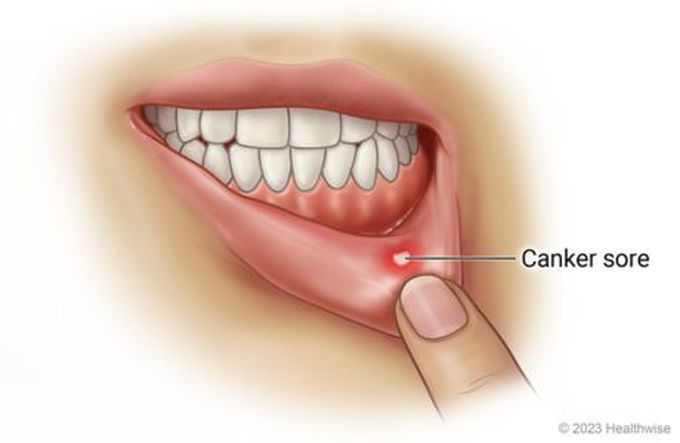 Canker Sores