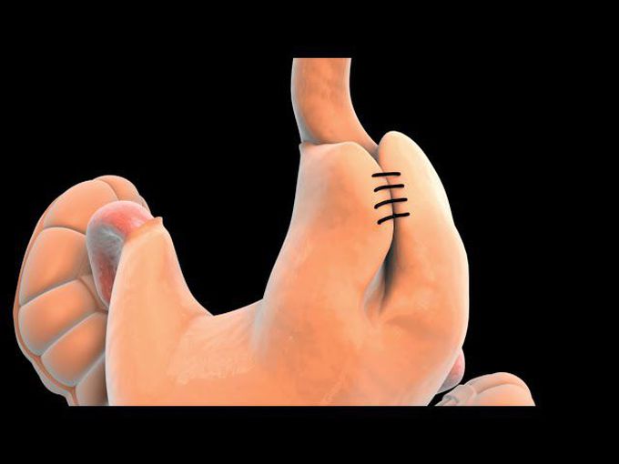 Surgery