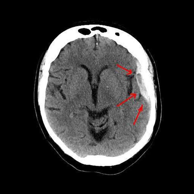 Cause of subdural hemtoma