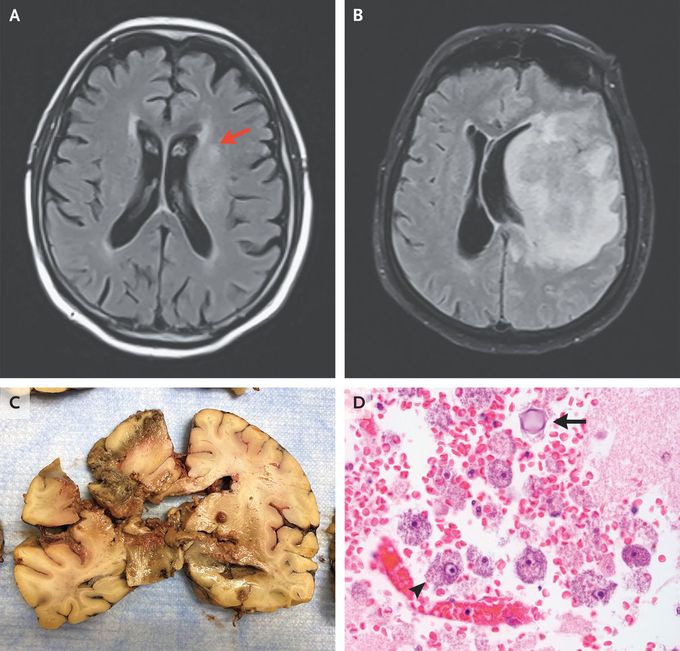 Granulomatous Amebic Encephalitis