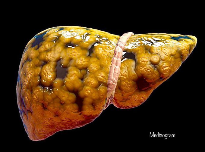 Hepatic Steatosis (Fatty Liver Disease)