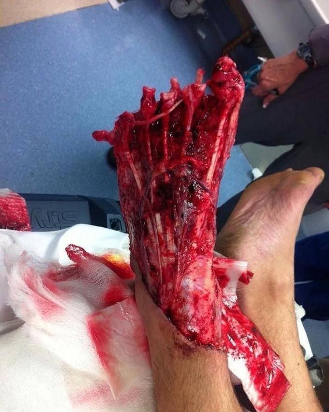 Horrible motorcycle accident with extensive foot trauma 