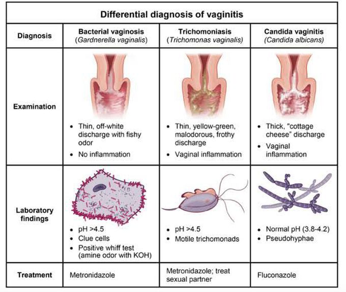 Differential Diagnosis of Vaginitis