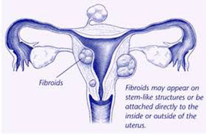 Treatment of fibroids