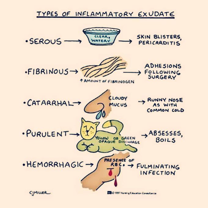 Types of inflammatory exudates!