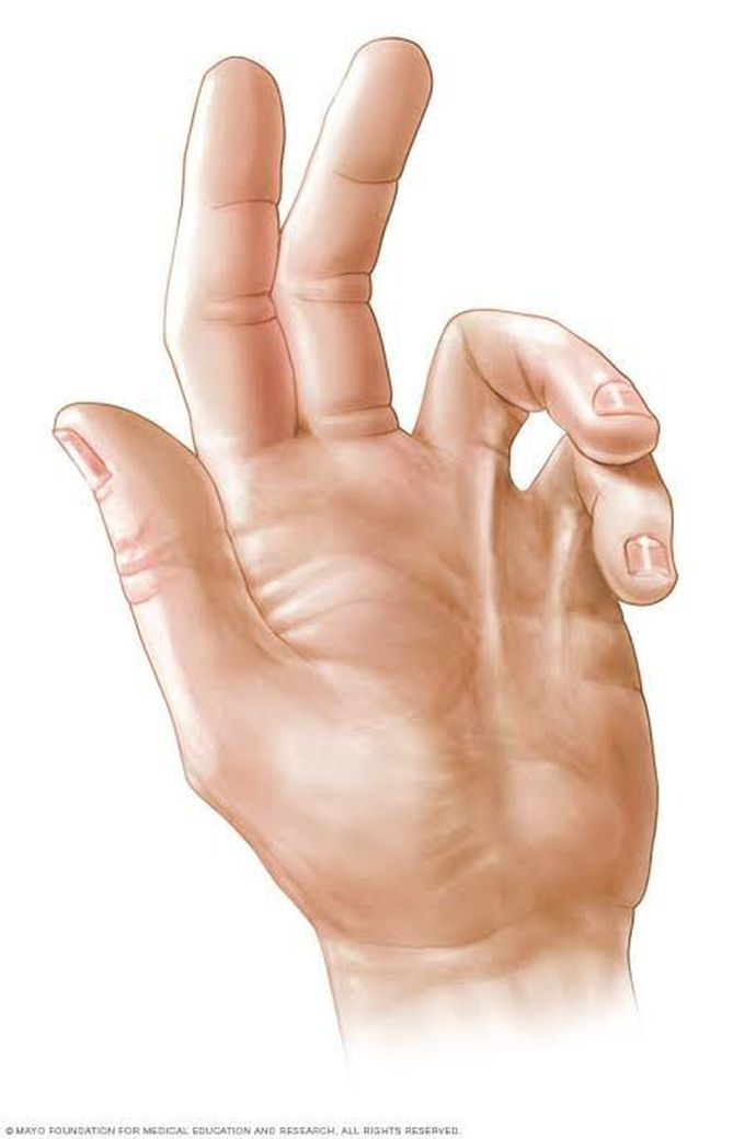 Dupuytren Contracture