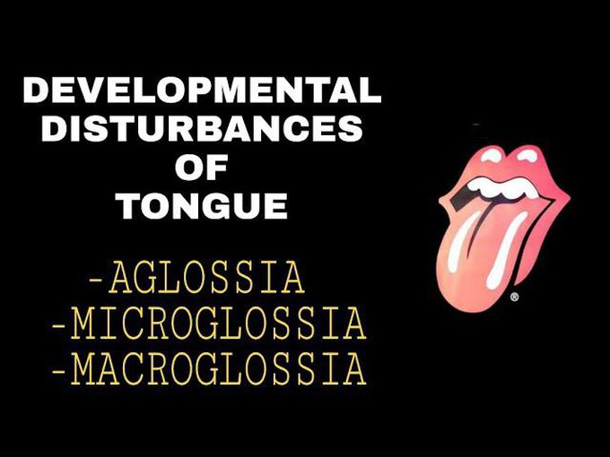 DEVELOPMENTAL DISTURBANCES OF THE TONGUE - AGLOSSIA , MICROGLOSSIA, MACROGLOSSIA