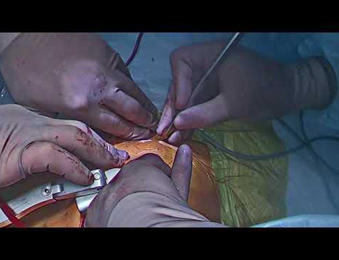 Minimally Invasive CABG With Mitral Valve Repair