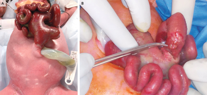 Closed Gastroschisis in Neonate Born at 37 weeks of Gestation