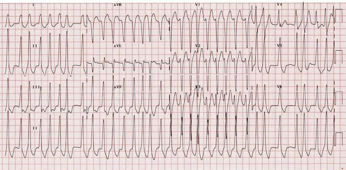 ECG  Diagnosis