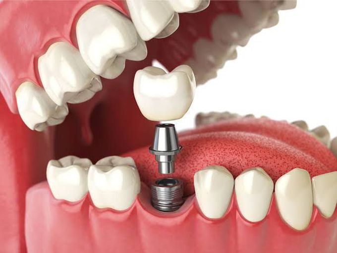 Risks of dental implant MEDizzy