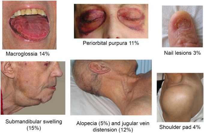 Amyloidosis