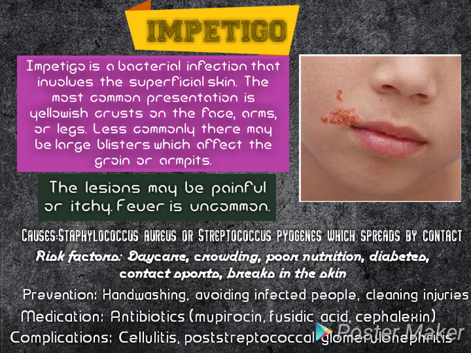 Impetigo