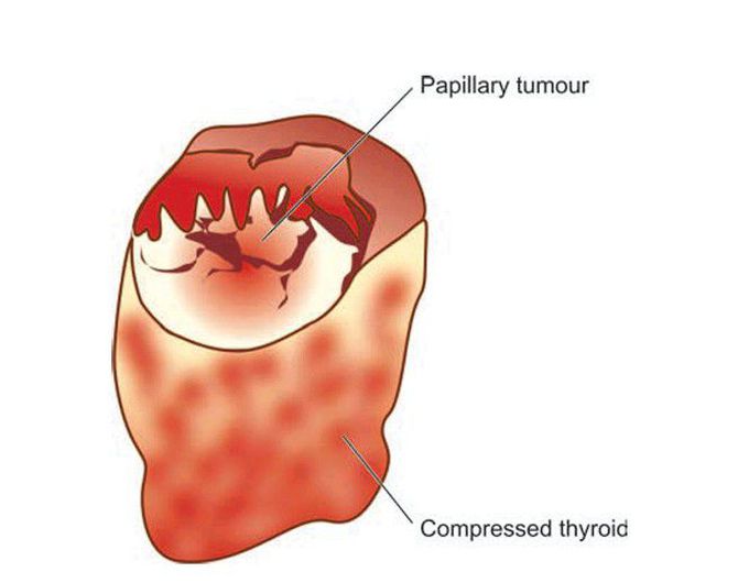 Papillary carcinoma of the thyroid