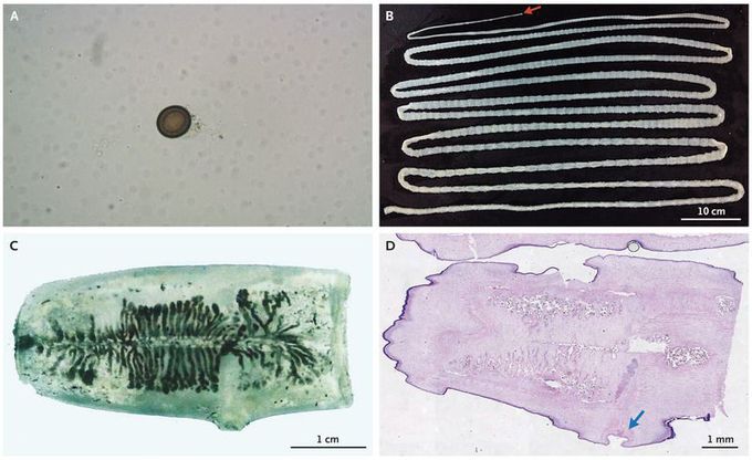 Taenia saginata Infestation