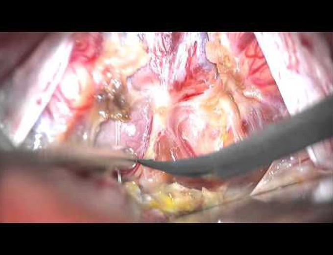 Supracerebellar infratentorial sitting craniotomy for a pinealoblastoma