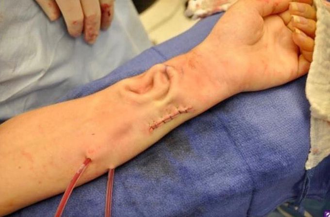 Ear on forearm