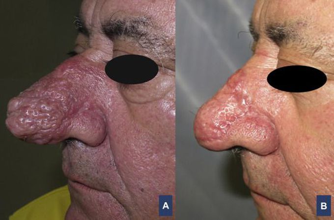 Management of Rhinophyma