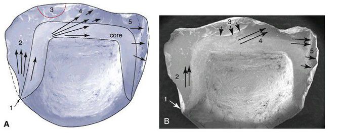 Determination of origin of fracture in a ceramic restoration