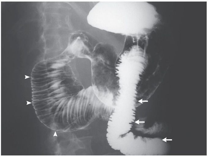 Megaduodenum in Systemic Sclerosis