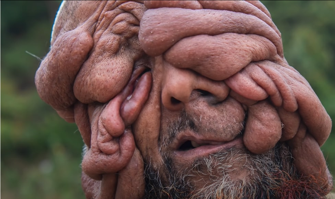 Can anyone tell what is the genodermatoses in which such skin features are seen&what other mucocutenous changes csn we get see in him if we examine.him throughly🤔🤔🤔