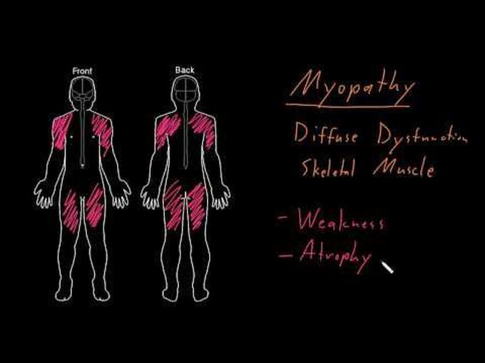 Myopathy syndrome- Basic