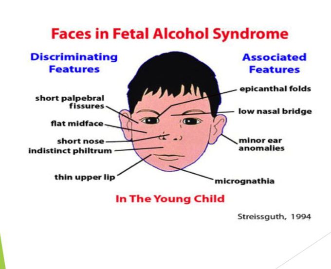 Fetal Alcoholic Syndrome - MEDizzy