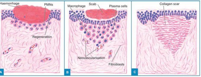 Secondary union of skin wounds