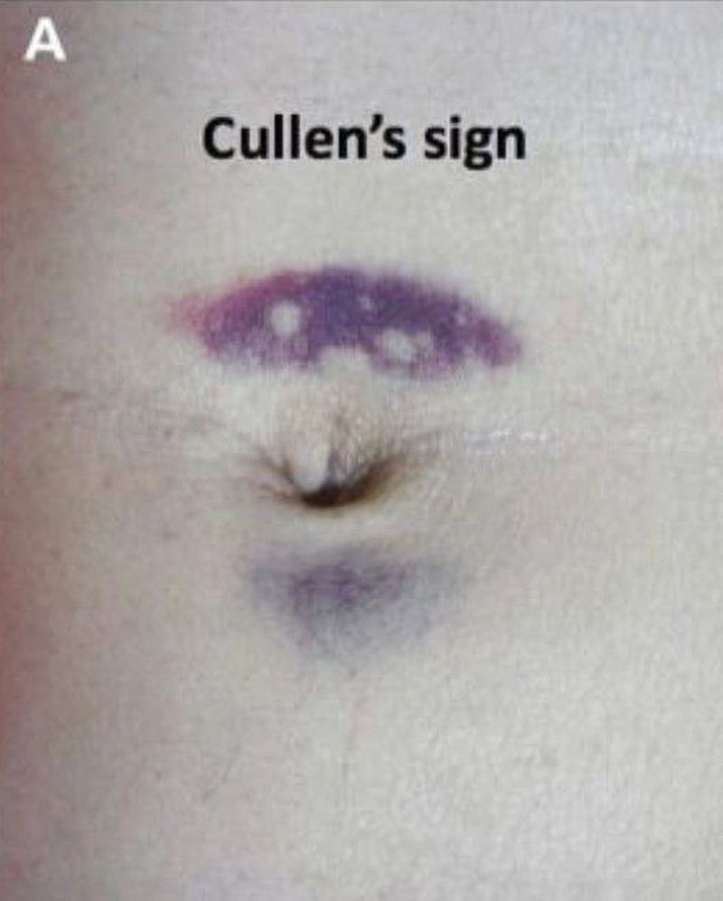 Cullen Sign And Turner Sign