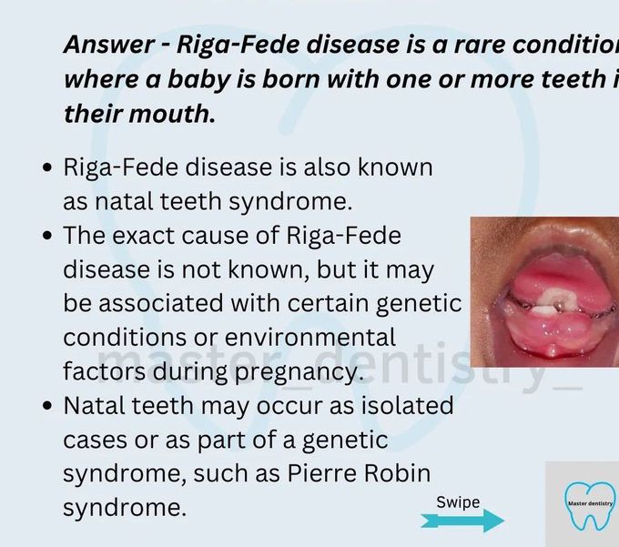 Riga-Fede Disease