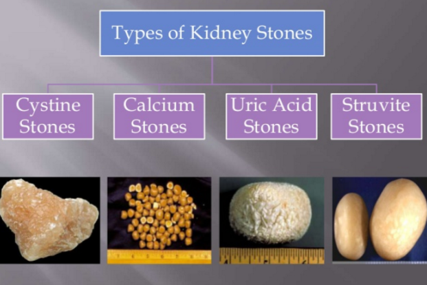 types-of-kidney-stones-medizzy