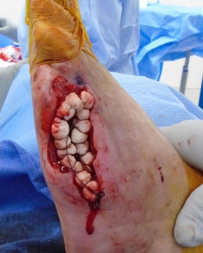 Diabetic foot operation