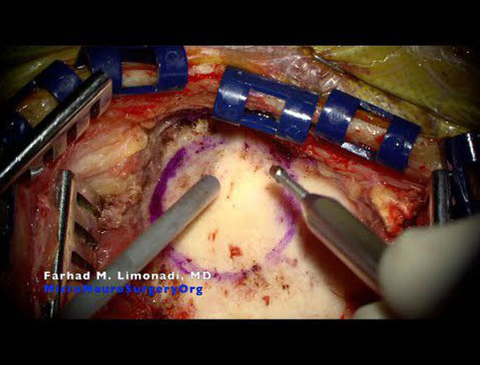 Brain surgery: Temporal craniotomy for resection of brain - MEDizzy