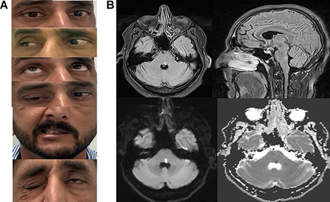 Eight-and-a-half Syndrome