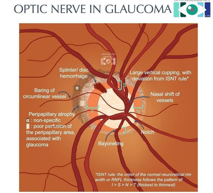 Optic Nerve Glaucoma