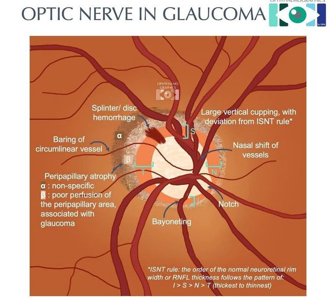 Optic Nerve Glaucoma
