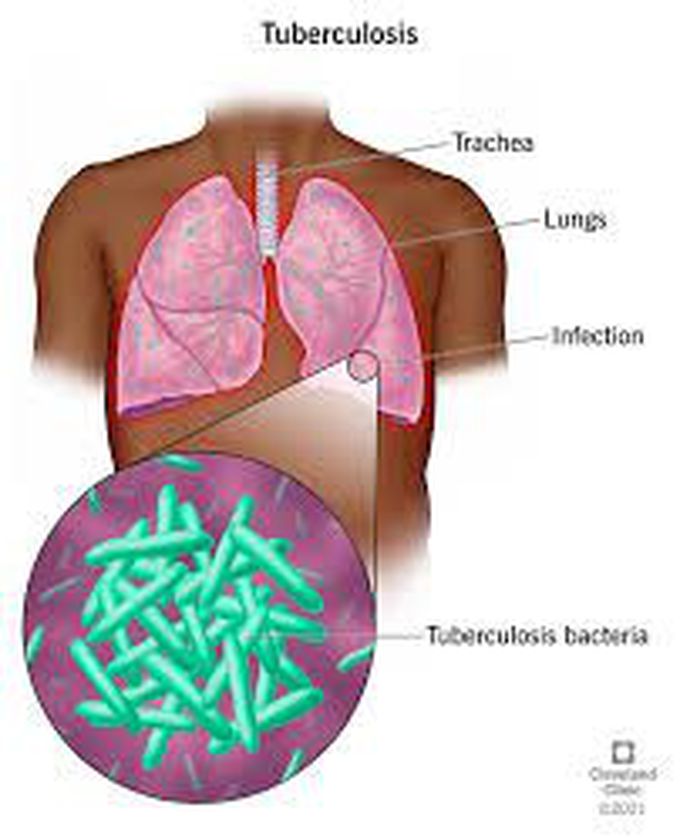 What causes tuberculosis?