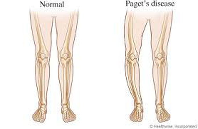 What is pagets disease - MEDizzy