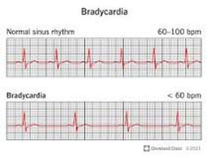 Bradycardia