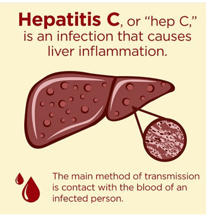 Hepatitis C